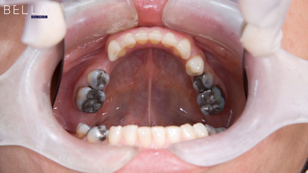 إعادة تأهيل الفم بالكامل في تركيا