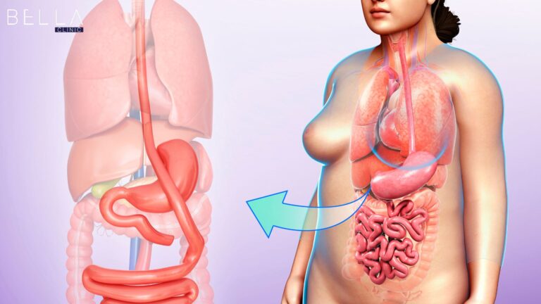 تكميم المعدة في تركيا