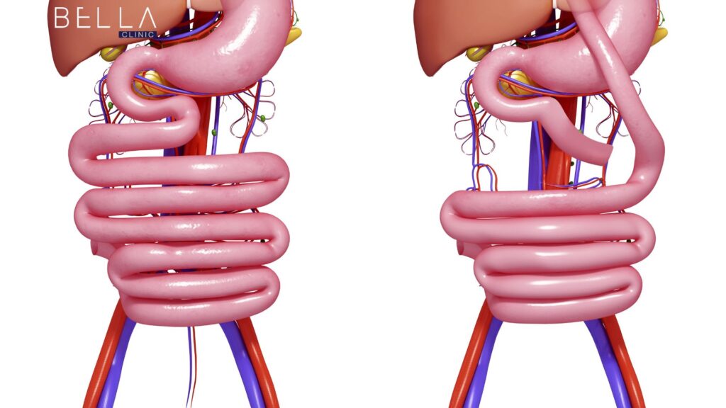 تحويل مسار المعدة في تركيا