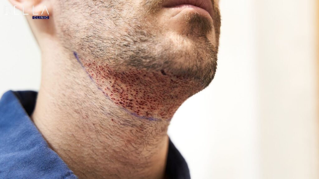 زراعة اللحية في تركيا