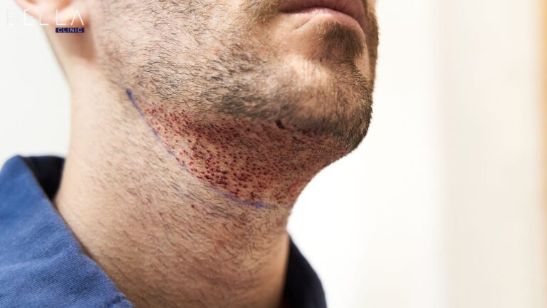 زراعة اللحية في تركيا