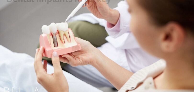 Dental Implants in turkey