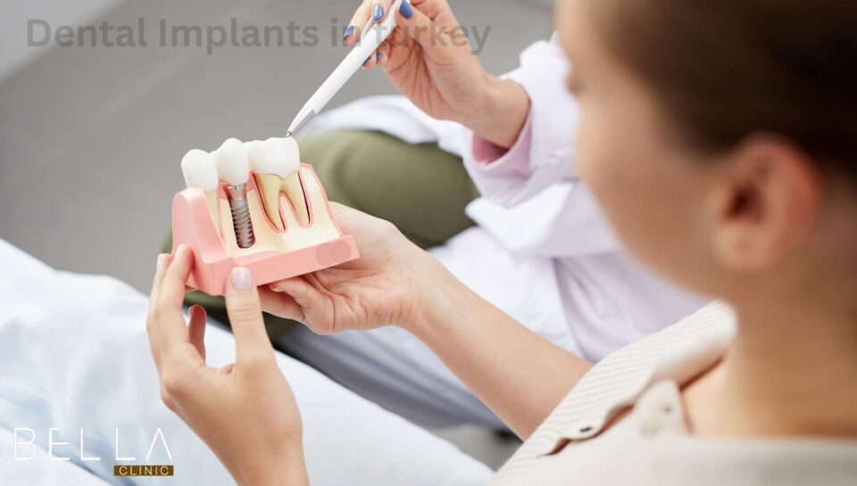 Dental Implants in turkey