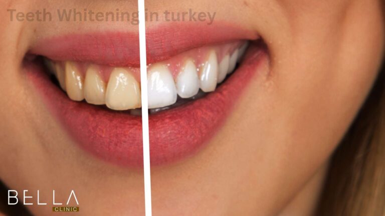 Teeth Whitening in turkey