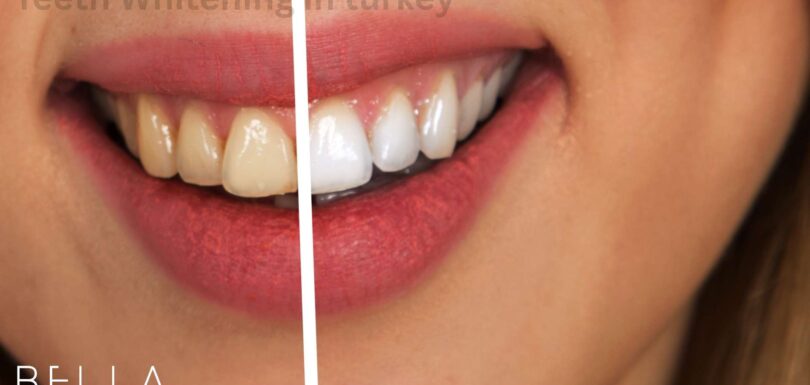 Teeth Whitening in turkey