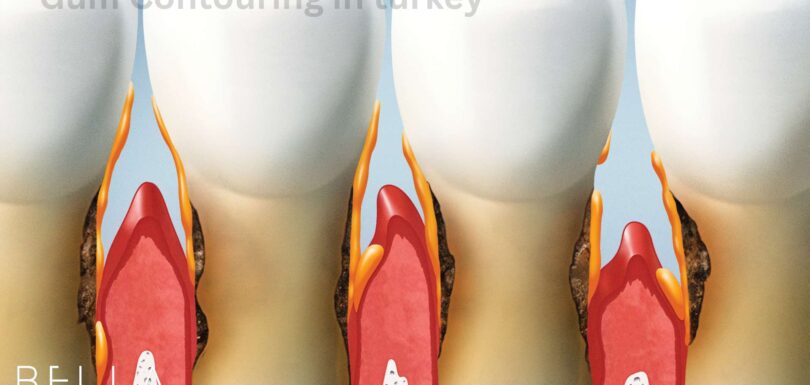 Gum Contouring in turkey