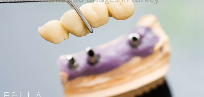 Dental Crowns and Bridges in turkey