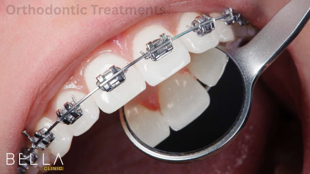 Orthodontic Treatments