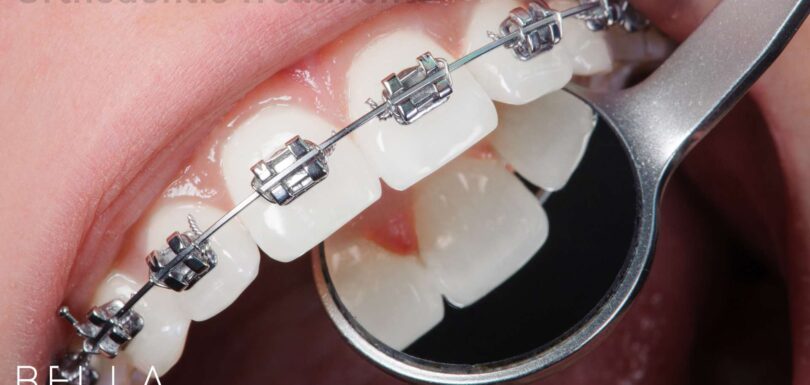 Orthodontic Treatments