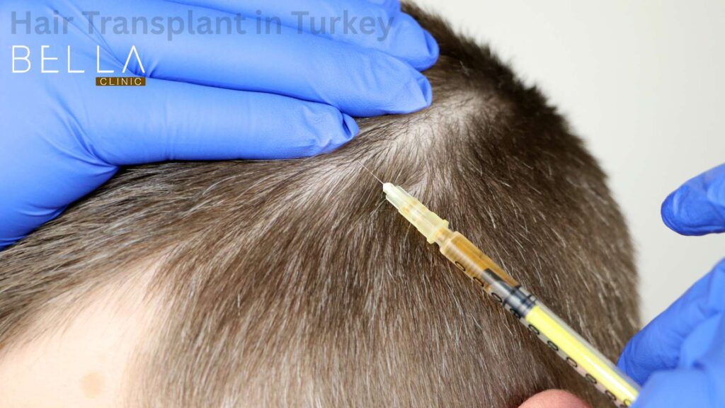 Hair Transplant in Turkey