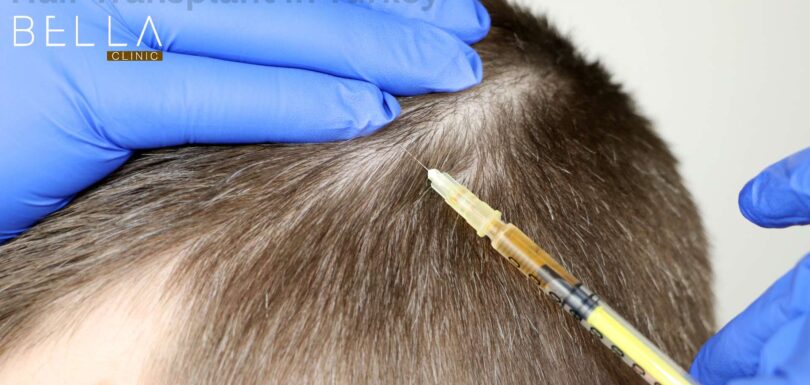 Hair Transplant in Turkey