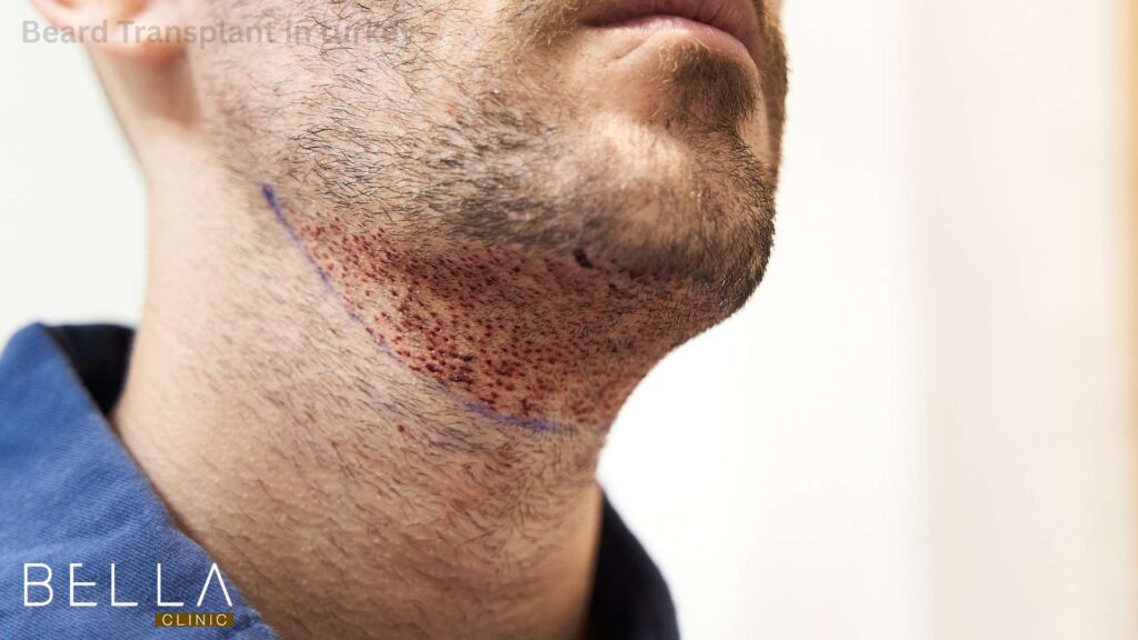 Beard Transplant in turkey