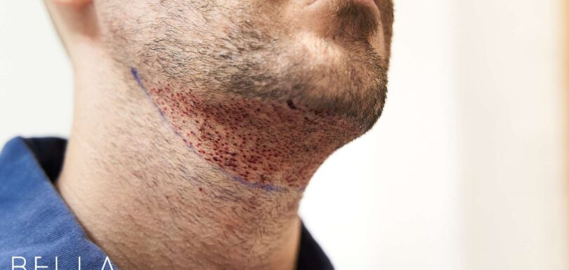 Beard Transplant in turkey