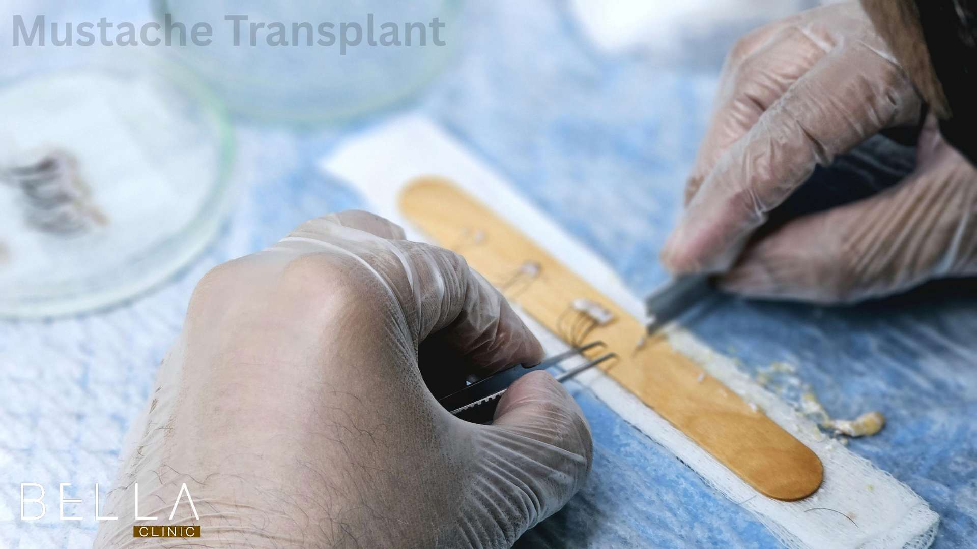 Mustache Transplant 2025 cost package before after best clinics - Bella ...
