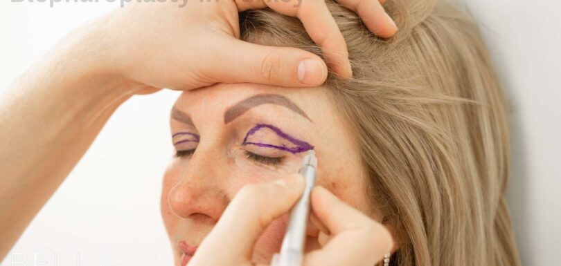 Blepharoplasty in Turkey