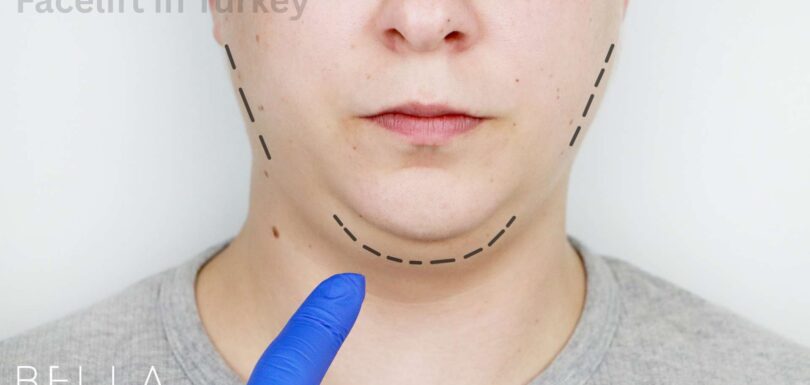 Facelift in Turkey