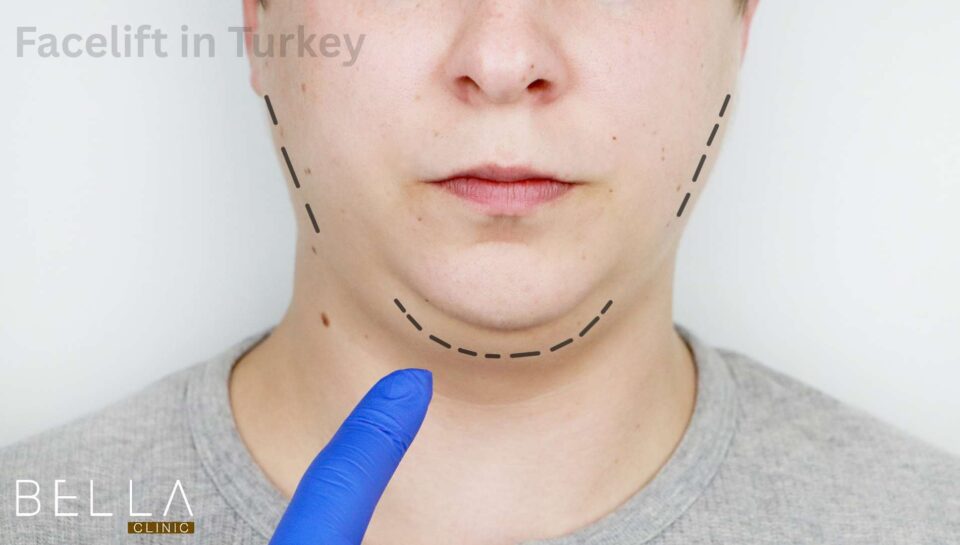 Facelift in Turkey