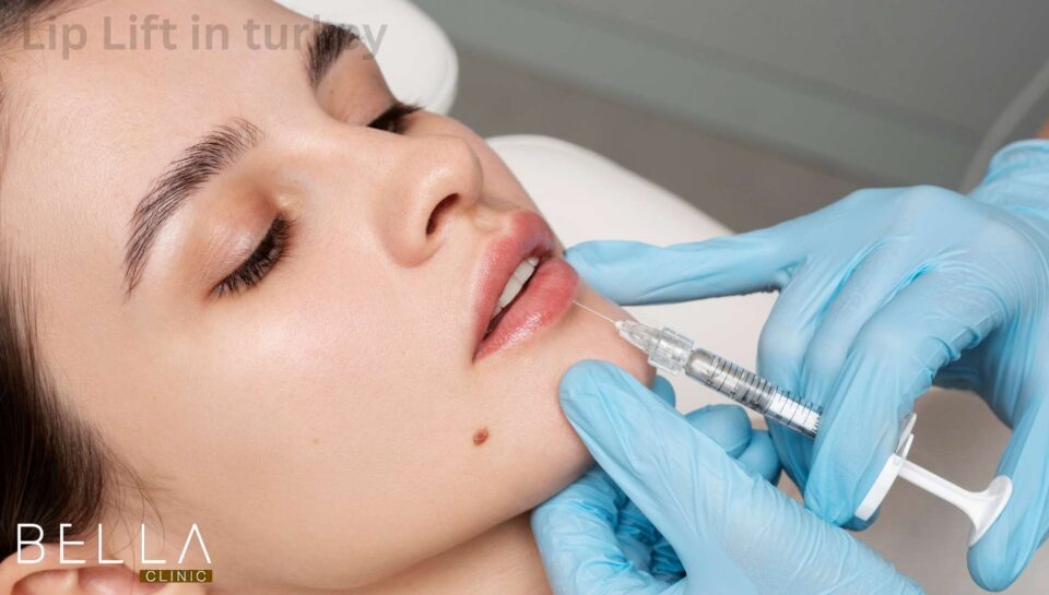 Lip Lift in turkey