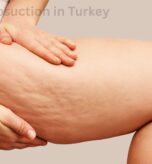 Thigh Lift in turkey