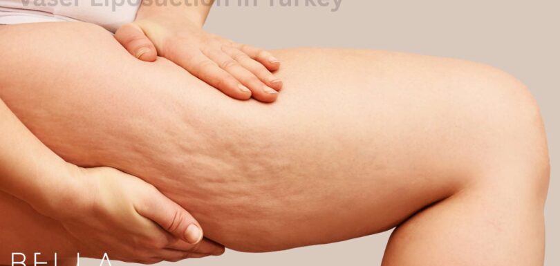 Thigh Lift in turkey