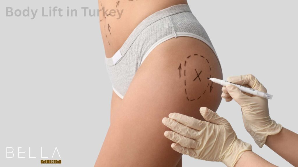 Body Lift in Turkey