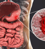 Gastric Bypass in turkey