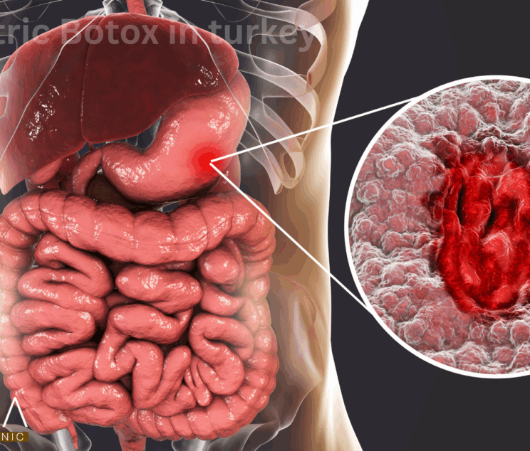 Gastric Bypass in turkey