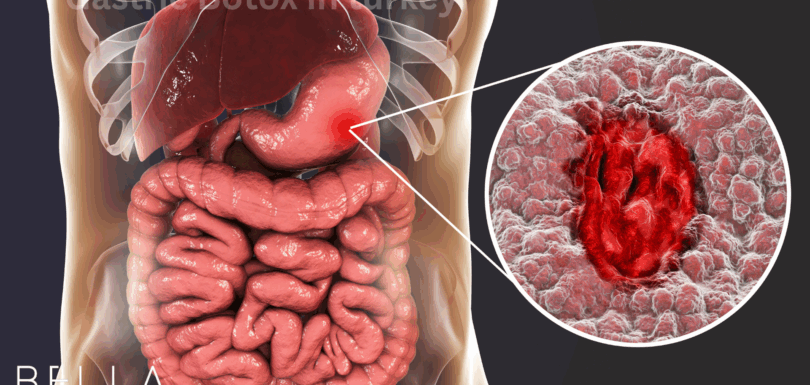 Gastric Bypass in turkey