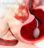 the Gastric Balloon in turkey