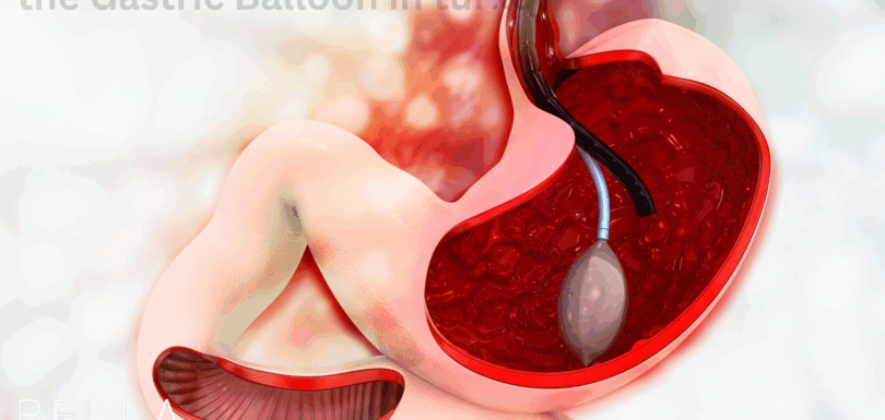 the Gastric Balloon in turkey