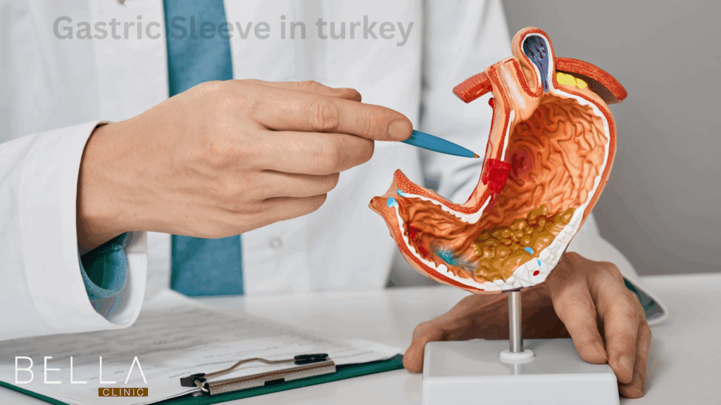Gastric Sleeve in turkey
