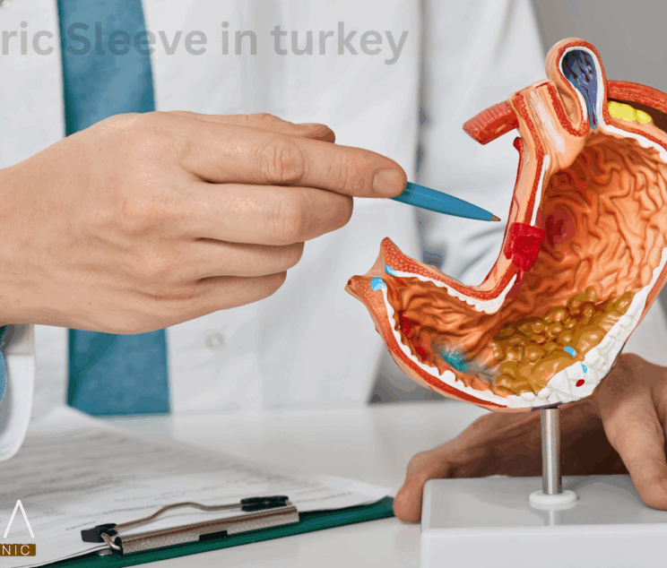 Gastric Sleeve in turkey