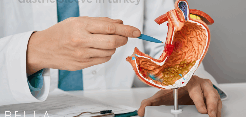 Gastric Sleeve in turkey