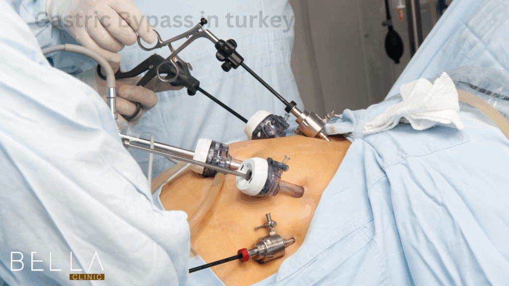 Gastric Bypass in turkey