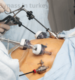 Gastric Bypass in turkey