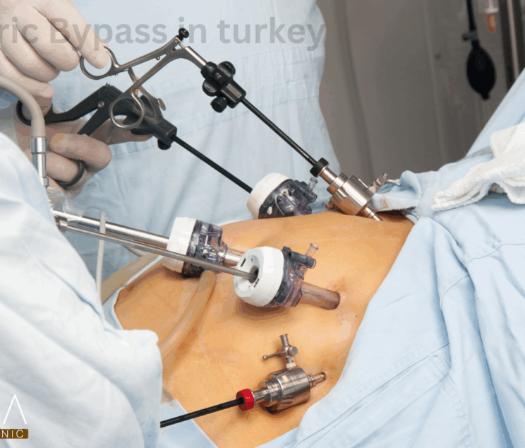Gastric Bypass in turkey