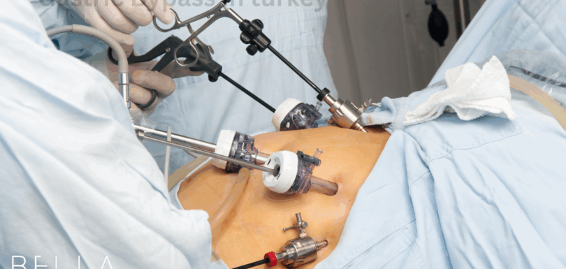 Gastric Bypass in turkey