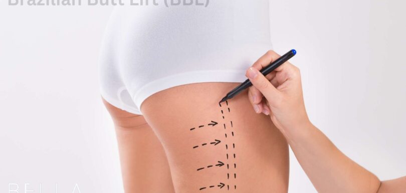 Brazilian Butt Lift (BBL)