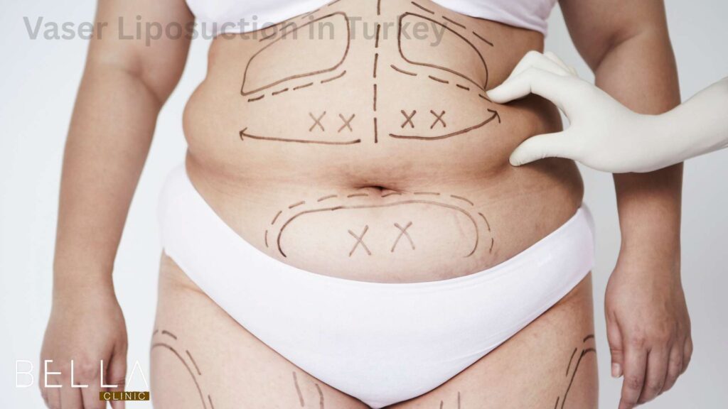 Vaser Liposuction in Turkey