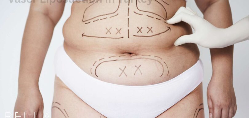 Vaser Liposuction in Turkey