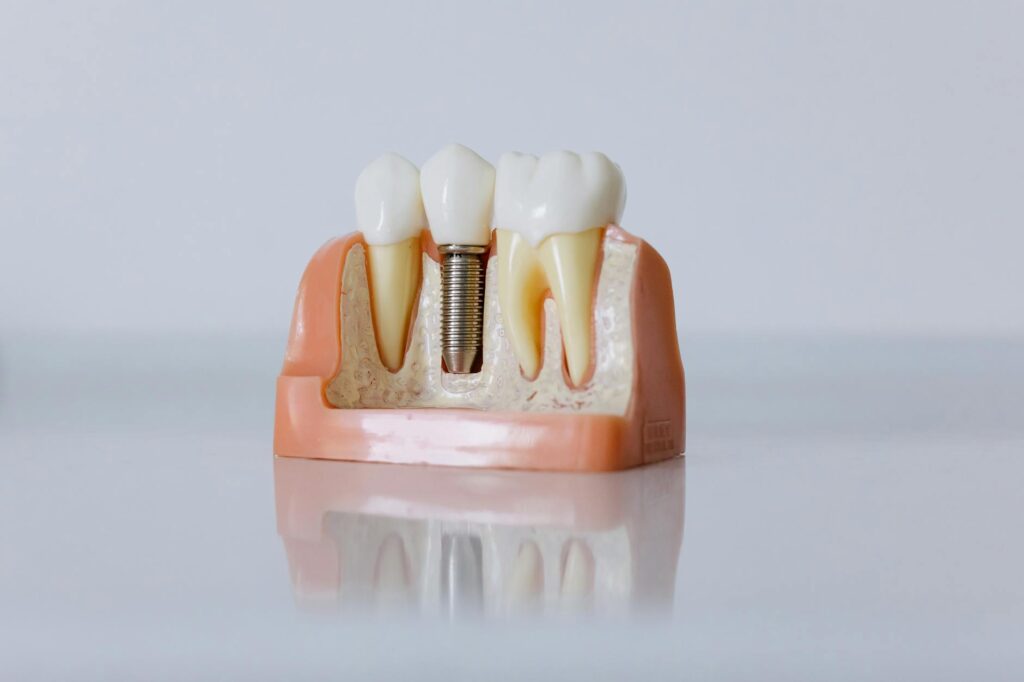 Dental Implants in turkey 2025