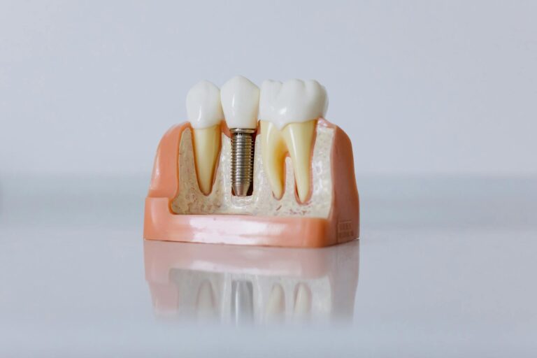 Dental Implants in turkey 2025