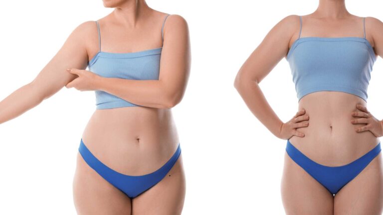 Liposuction in Turkey Before and After