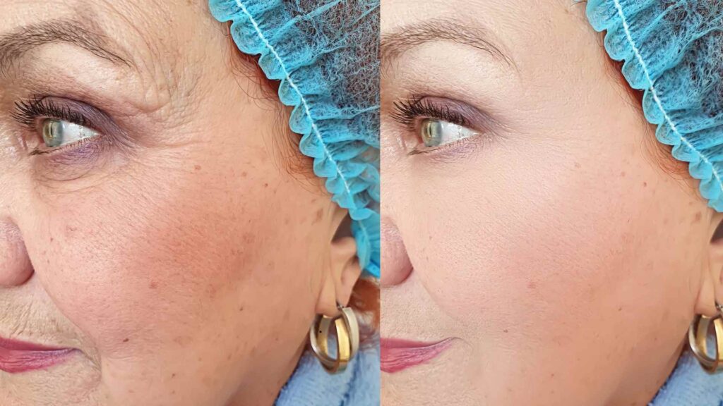 breast lift before and after