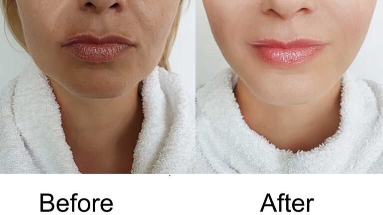 rhinoplasty before and after turkey