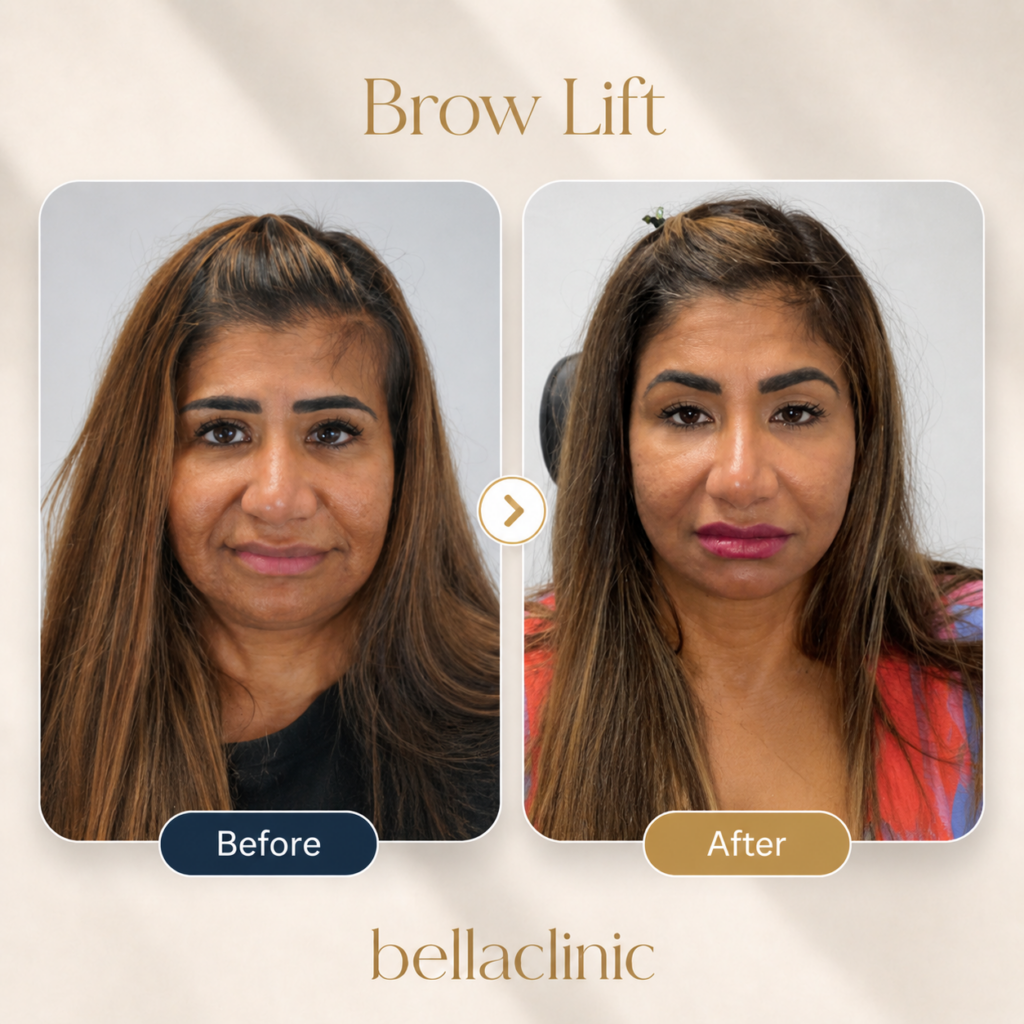 Eyebrow Lift before and after result