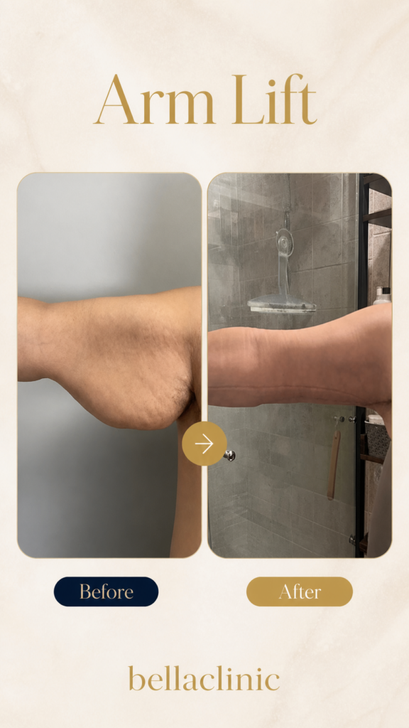 Arm Lift before and after result