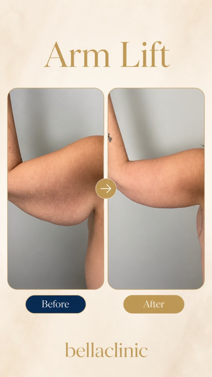 Arm Lift