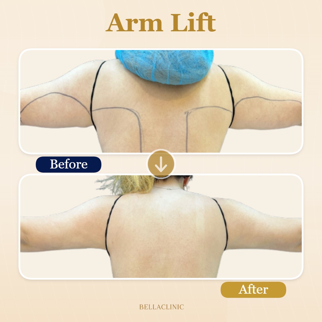 Arm Lift