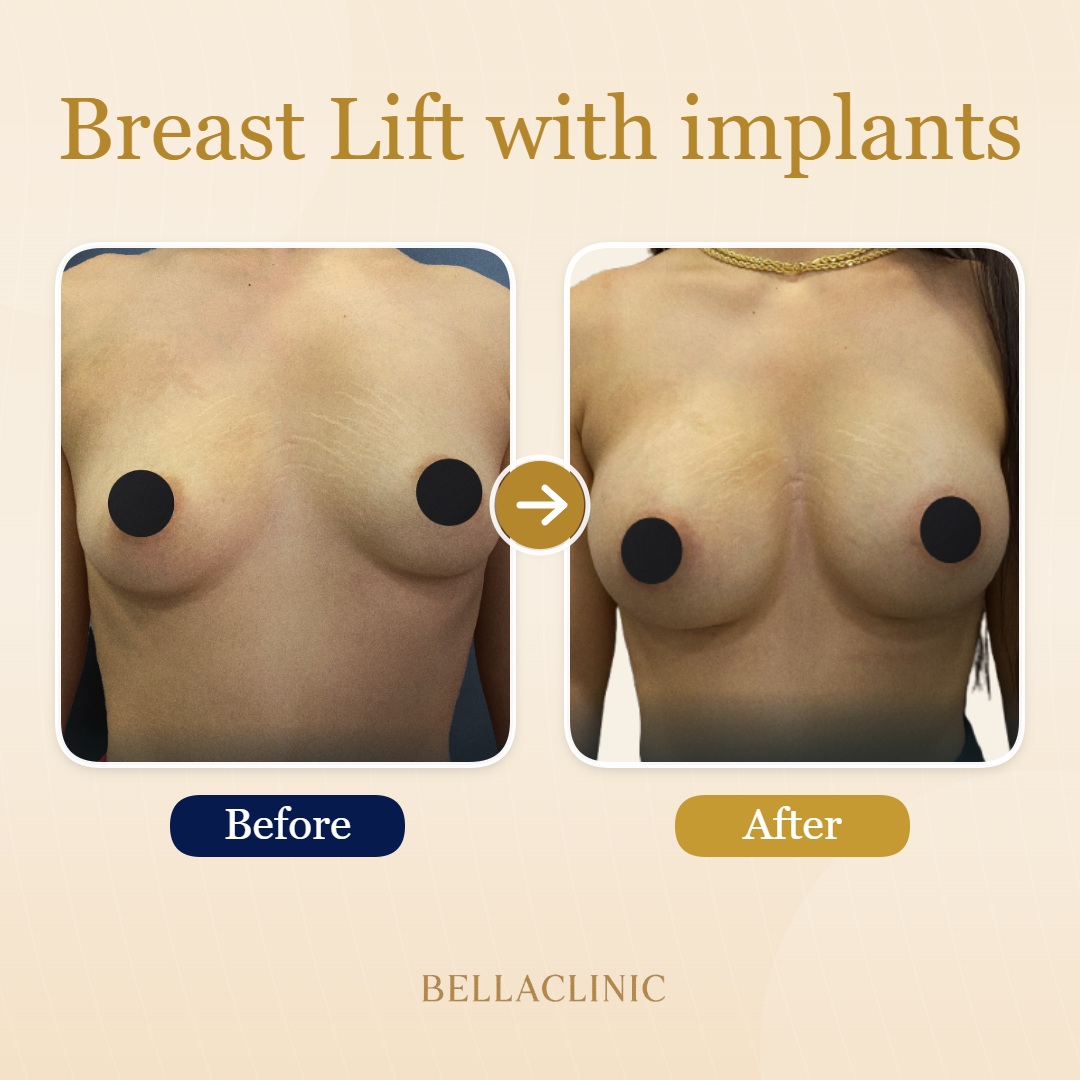 Breast Lift with implants